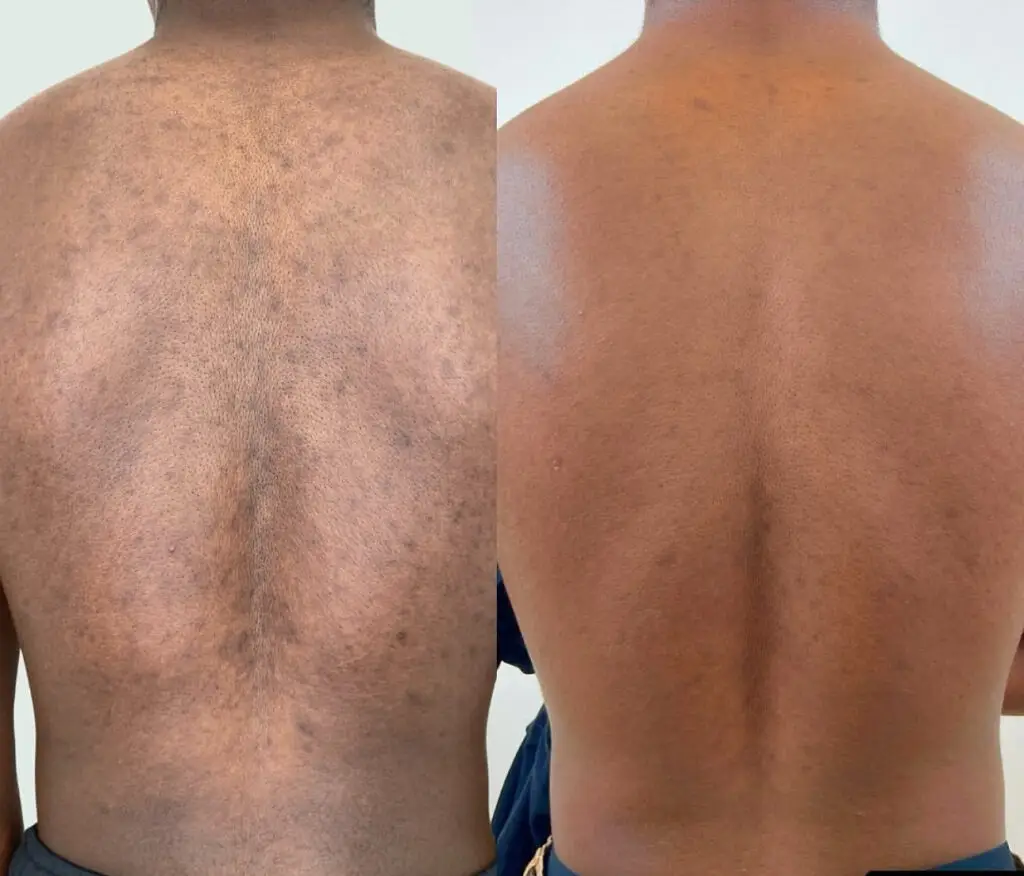 The-Melanin-Studio-best-spa-in-edmonton-yeg-alberta-laser-black-owned-dermaplaning-medspa-facials-luxury-spa-Before-and-after-hyperpigmnetation-melanin-skin-acne-scarring.PNGalberta
