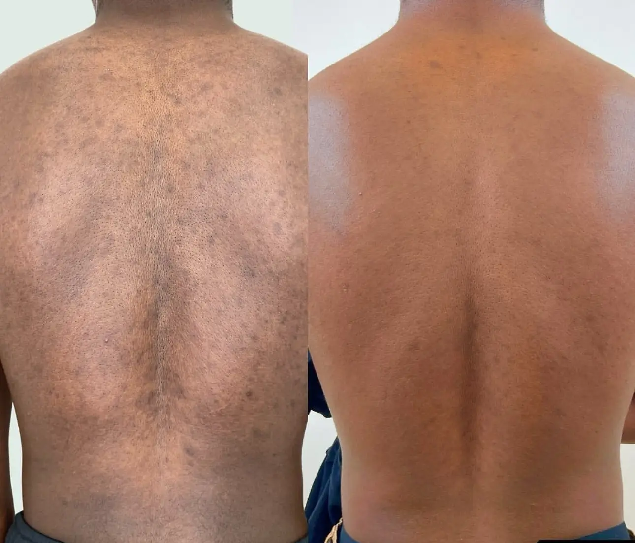 The-Melanin-Studio-best-spa-in-edmonton-yeg-alberta-laser-black-owned-dermaplaning-medspa-facials-luxury-spa-Before-and-after-hyperpigmnetation-melanin-skin-acne-scarring.PNGalberta