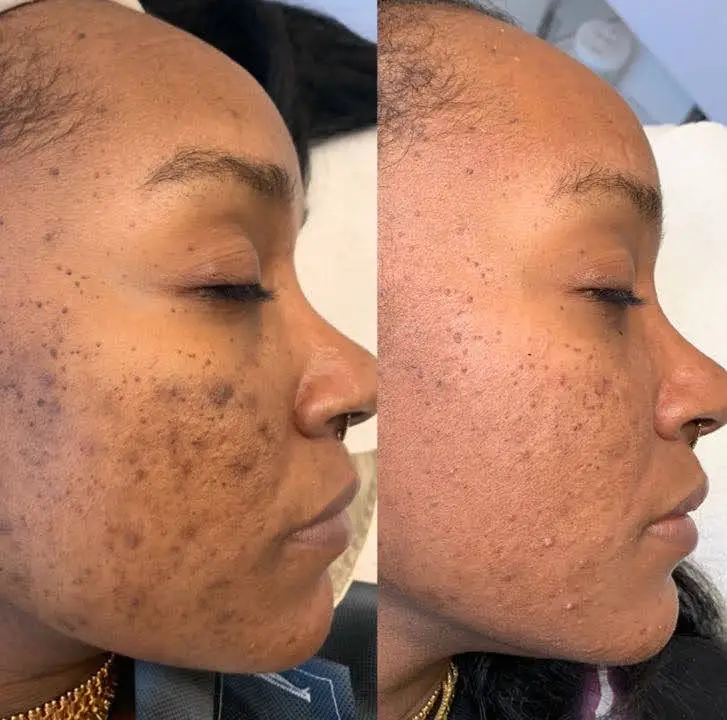 The-Melanin-Studio-best-spa-in-edmonton-yeg-alberta-laser-black-owned-dermaplaning-medspa-facials-luxury-spa-calgary-Before-and-after-hyperpigmnetation-melanin-skin-acne-scarring.PNG